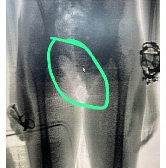 Advogada é flagrada tentando entrar na PCE com cigarros escondidos nas partes íntimas