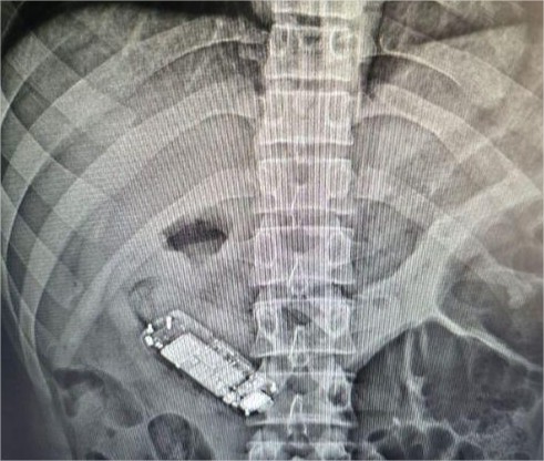 Presidiário engole celular e vai parar na UPA