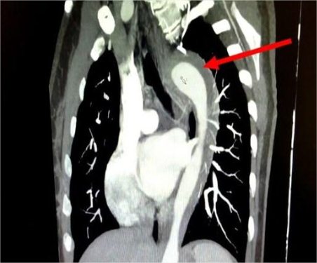 Mulher rompe aorta após orgasmo e sobrevive a condição rara e potencialmente fatal