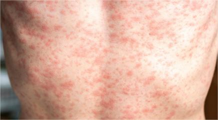 Cuiabá emite alerta para sarampo após Bolívia declarar emergência