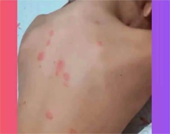 Surtos de alergia sem causa definida provoca manchas e coceira em moradores de município de MT
