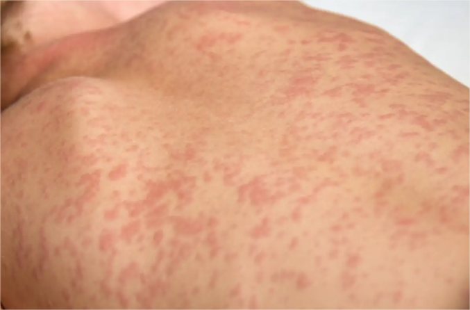 Cidade de Mato Grosso tem o 4º caso de sarampo confirmado