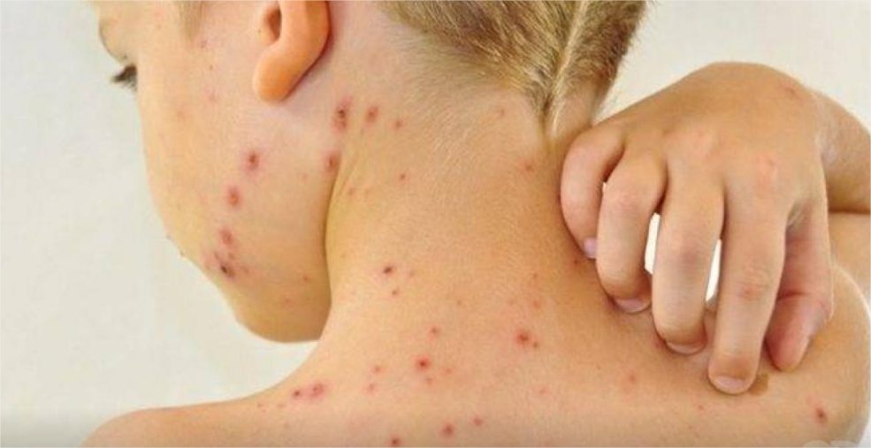 Confirmado o quinto caso de sarampo em cidade de MT