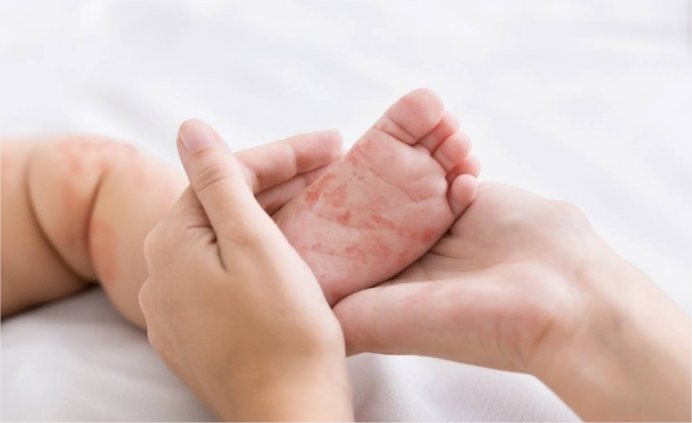 Tangará da Serra investiga caso suspeito de sarampo em bebê de 4 meses