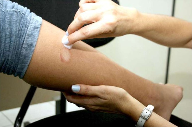 Atenção! Monitoramento aponta explosão de casos de hanseníase em MT