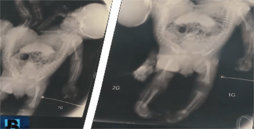 Gêmeos siameses de casal em MT devem ser separados em um ano