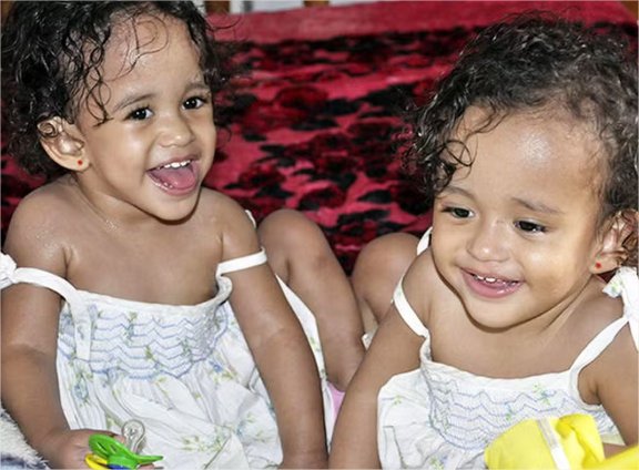 Veja como vivem as primeiras gêmeas siamesas de MT que passaram por cirurgia de separação há 15 anos