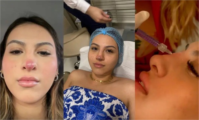 Miss tem nariz necrosado após procedimento estético em Cuiabá