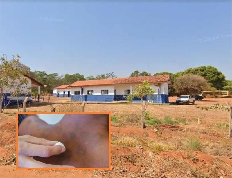 Moradores denunciam surto de hanseníase em distrito de MT; escola estaria contaminada